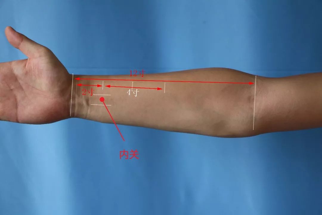 内关穴定位:在前臂前区,腕掌侧远端横纹上2寸,掌长肌腱与桡侧腕屈肌腱