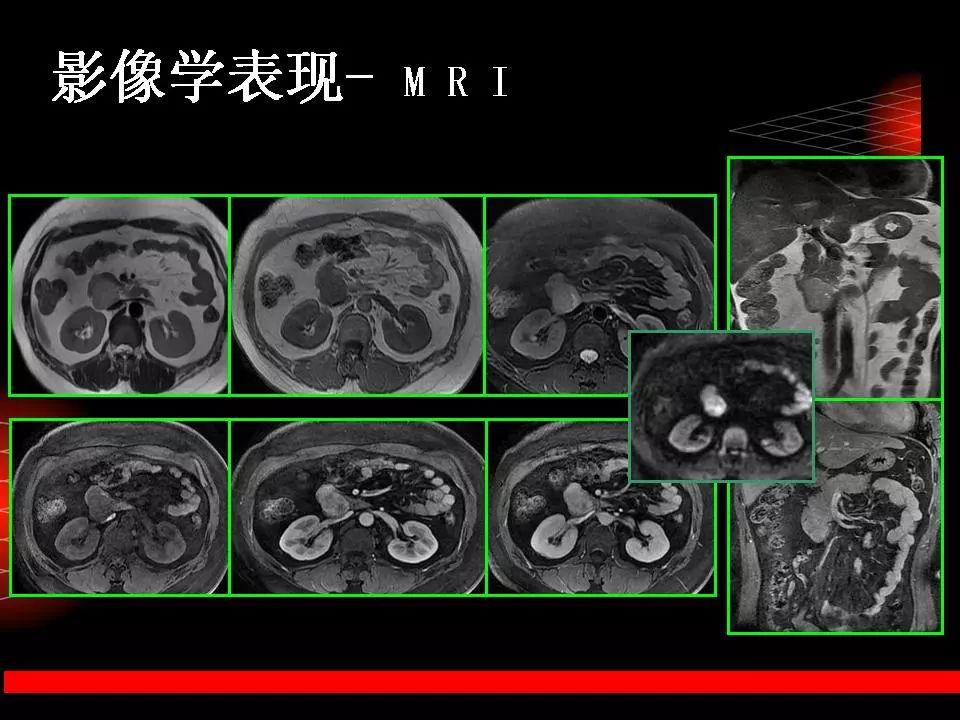 胃肠道间质瘤影像诊断与鉴别诊断 | 影像天地