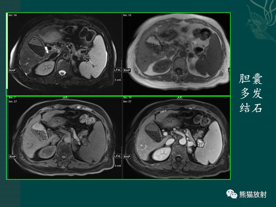 胆系病变丨ct及mri诊断