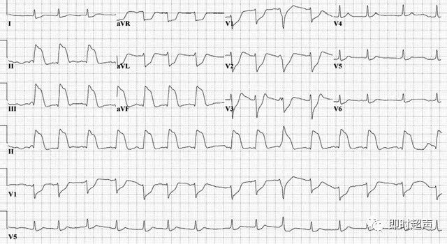 st 段抬高型心肌梗死(图 1),入院后又出现一次无脉性电活动(pea),心电