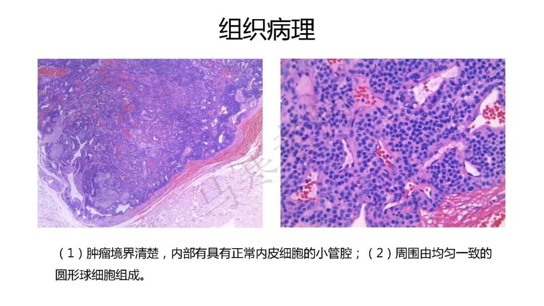 jaad微课堂五十一甲下血管球瘤的临床病理诊断与手术治疗