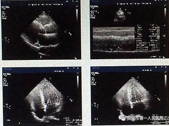 心脏彩超要脱内衣吗_心脏彩超图片