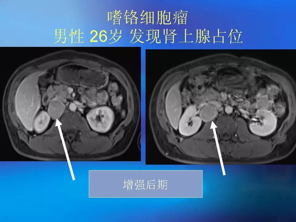 肾上腺髓质肿瘤的影像诊断及鉴别诊断影像天地