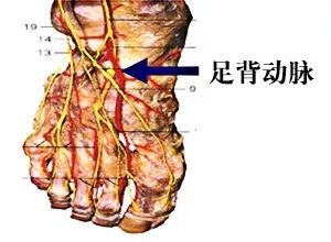 一般而言,如果足背动脉搏动发生变化,可能预示着 动脉出了问题,血管