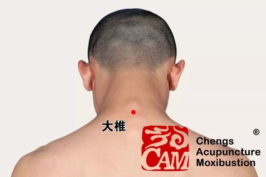 大椎三阳督脉之会