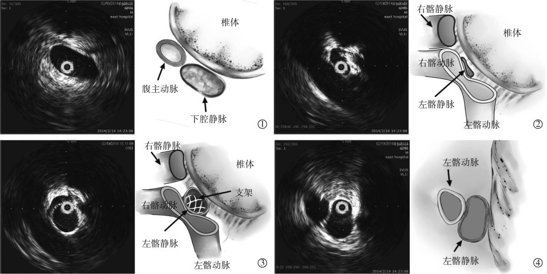 前沿技术血管内超声在非血栓性髂静脉受压综合征诊治中的价值