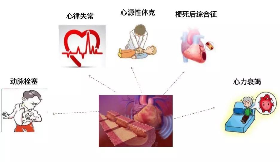 尤其是7月的炎热期,心绞痛,急性心肌梗死,急性左心衰竭,心律失常,心源