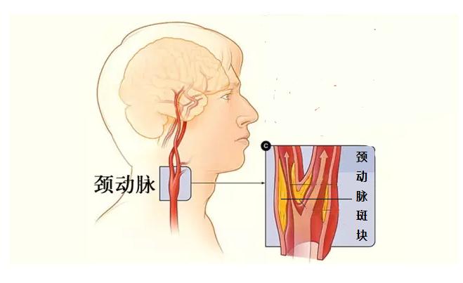 查出颈动脉斑块严重吗?医生坦言:有的会诱发脑梗,最好赶紧治