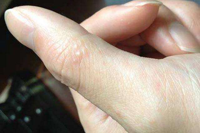 常常在手上挠出的"小水泡"该如何消除,为你一一解答"汗疱疹"