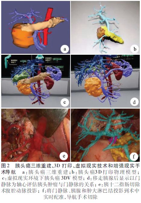 数字智能化诊疗技术在胰腺癌中的应用_肿瘤