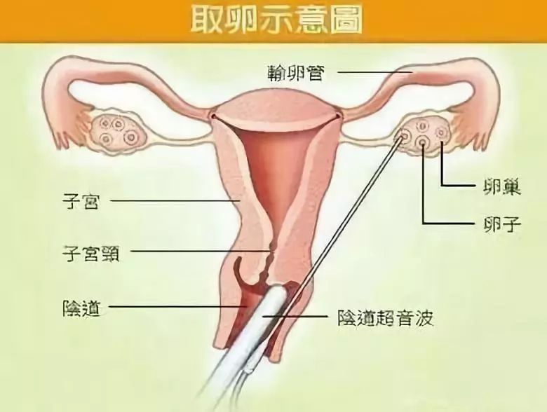 麦默通手术多久穿内衣_美女只穿内衣(2)