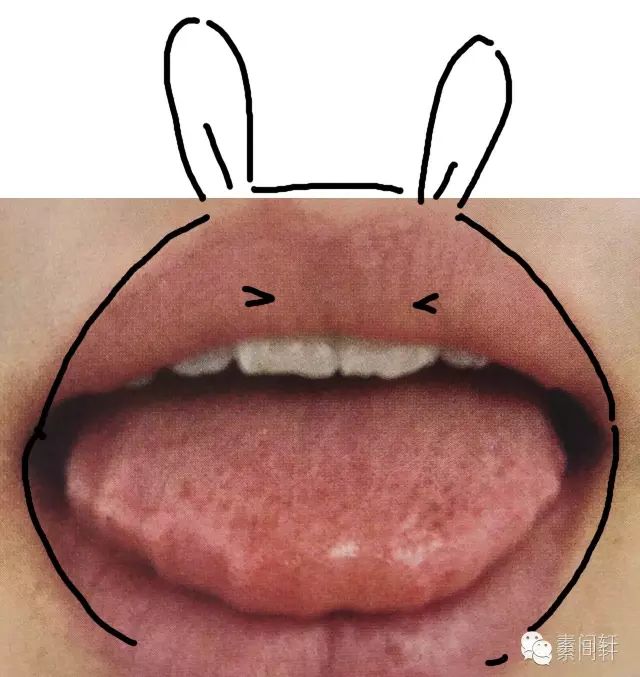薄白苔 舌质红 ▼ 代表里有热证 见于实热或者阴虚; (一般阴虚的舌头