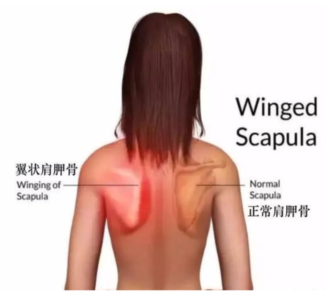 根据百度百科上的解释,翼状肩胛就是"正常人的肩胛骨紧贴胸壁,前锯肌