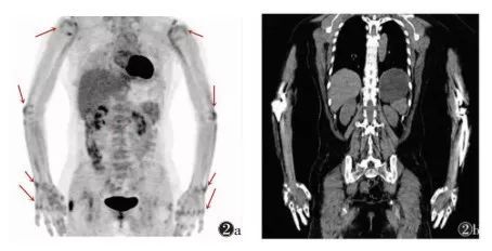 PET-CT对多种风湿免疫系统疾病早期诊断