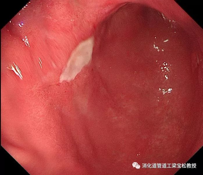 必须活检的胃溃疡