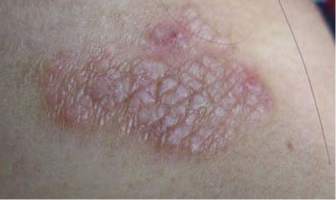 神经性皮炎的典型皮疹呈苔藓样斑块状,瘙痒剧烈,鳞屑较少,且无薄膜