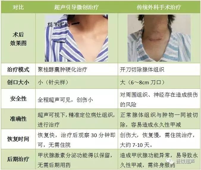 病例分享甲状腺囊肿超声引导下聚桂醇硬化治疗