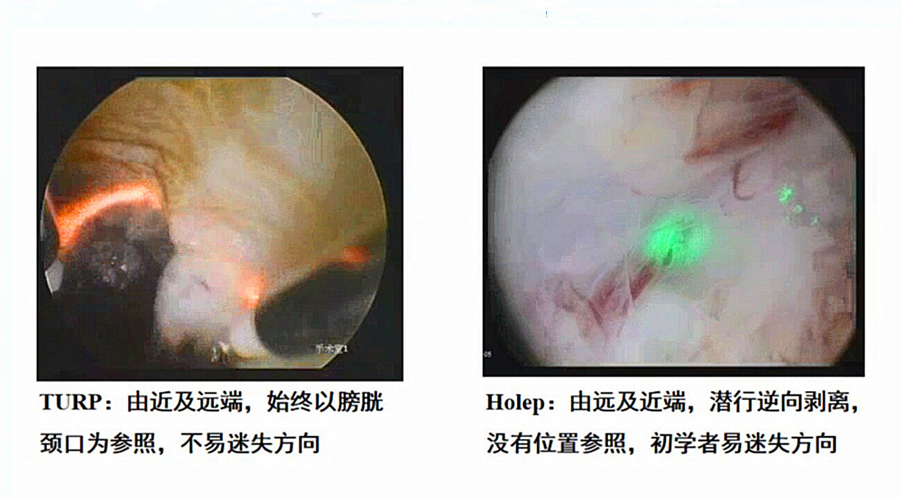 前列腺增生症微创治疗的金标准---TURP (