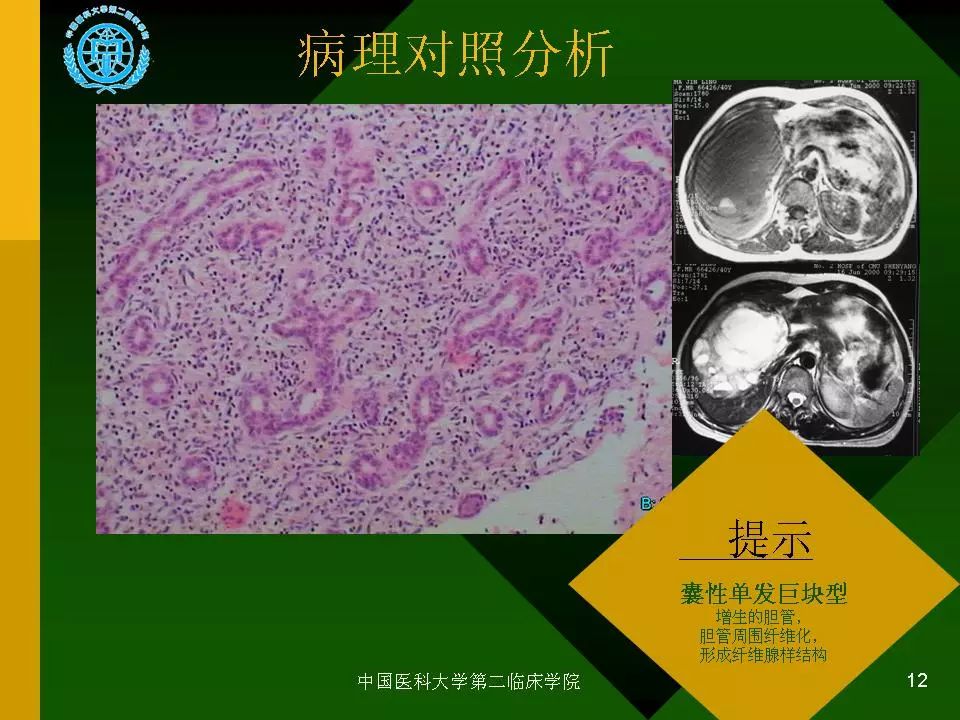 小儿肝脏间叶性错构瘤的mri表现 | 影像天地