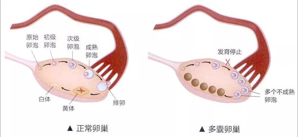 多囊卵巢综合征4早期月经不正常,但随后由于卵巢内的卵泡已经耗竭