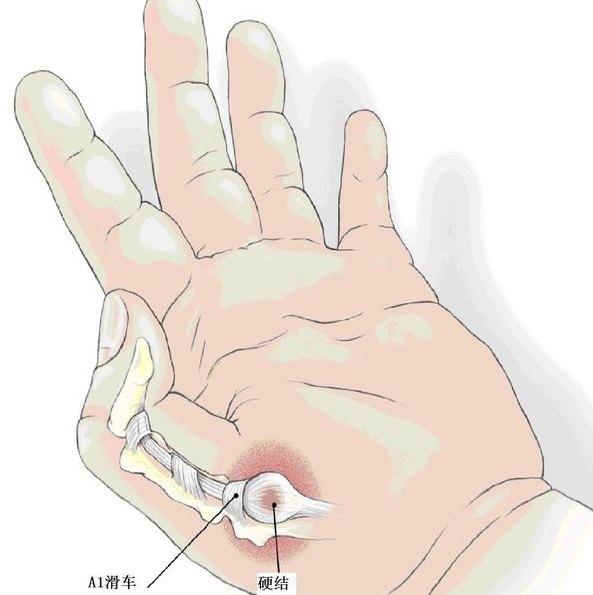 先天性拇指腱鞘炎(扳机指)