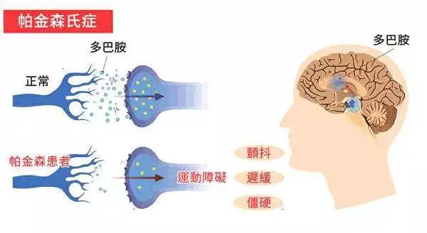 帕金森人口_男性大脑衰老速度更快 更易患帕金森