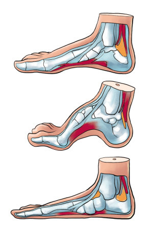 外科特色之四:微创手术治疗平足症 (原创)