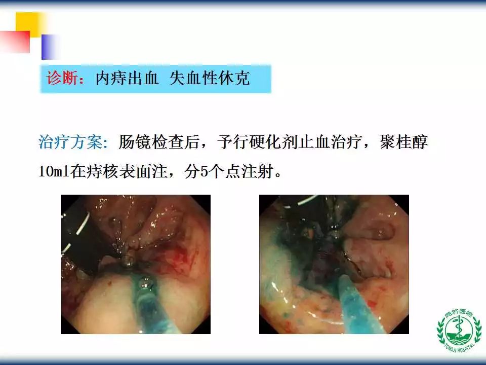 教学ppt内镜下内痔硬化规范化治疗