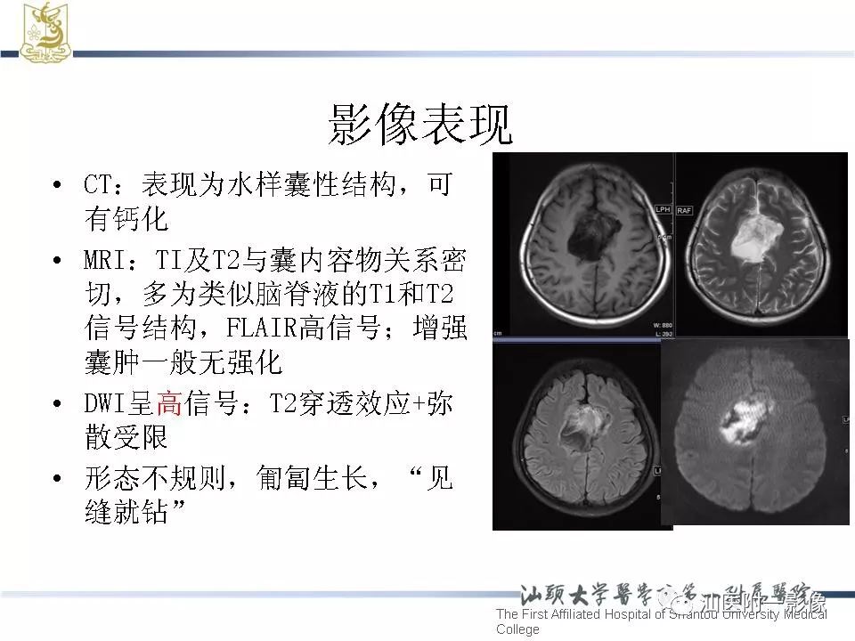 影像基础颅内表皮样囊肿影像表现