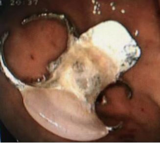 活动义齿怎么取下来 8f6b07a6d6f045b5bdc2746a09a13cb2.jpeg