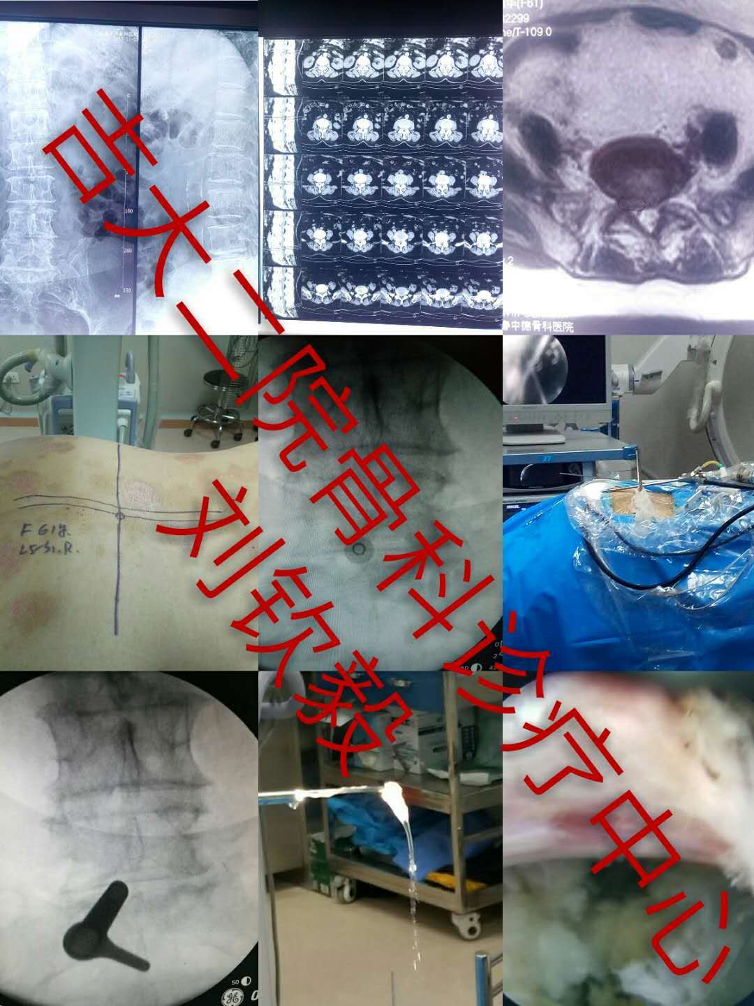 腰间盘突出微创手术是什么原理_腰间盘突出微创手术图