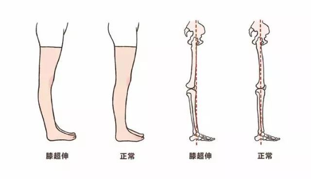 原创小腿弯成回形针还能走chanel秀?没想到,刘诗诗也有这个体态问题