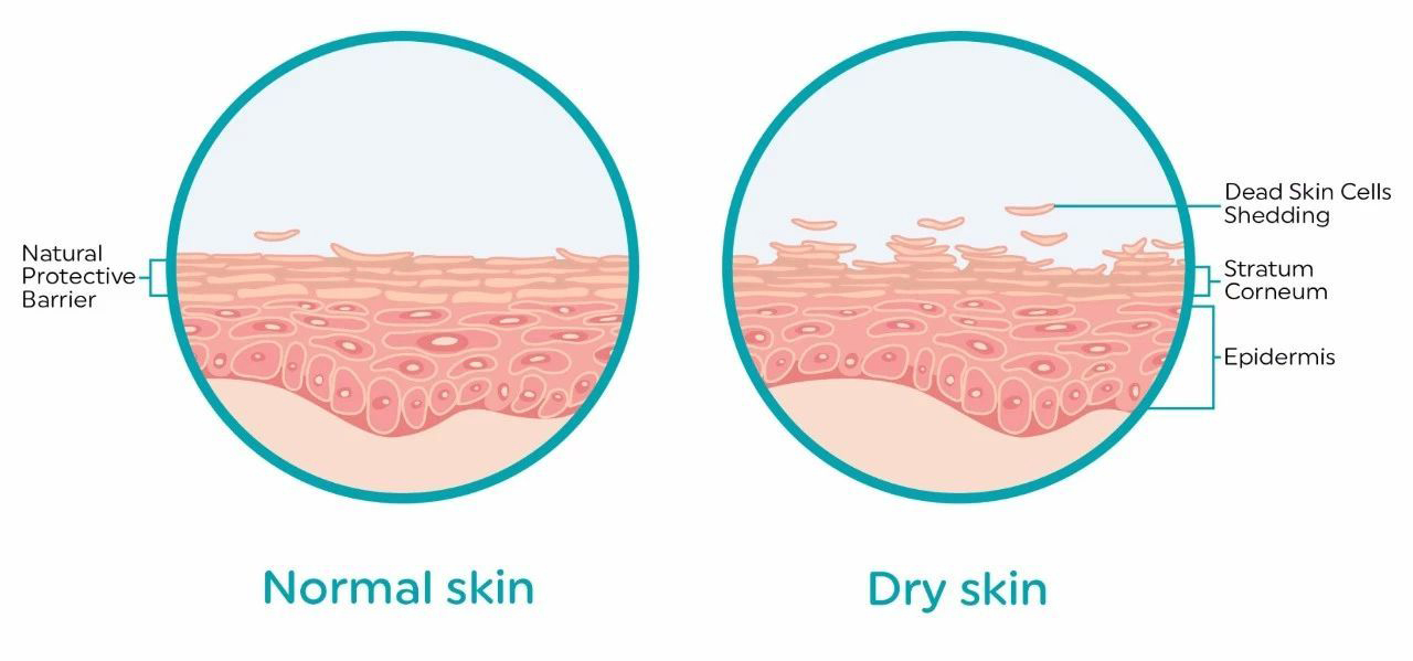 干性皮肤:先天缺损的角质层结构 不足的皮脂分泌.