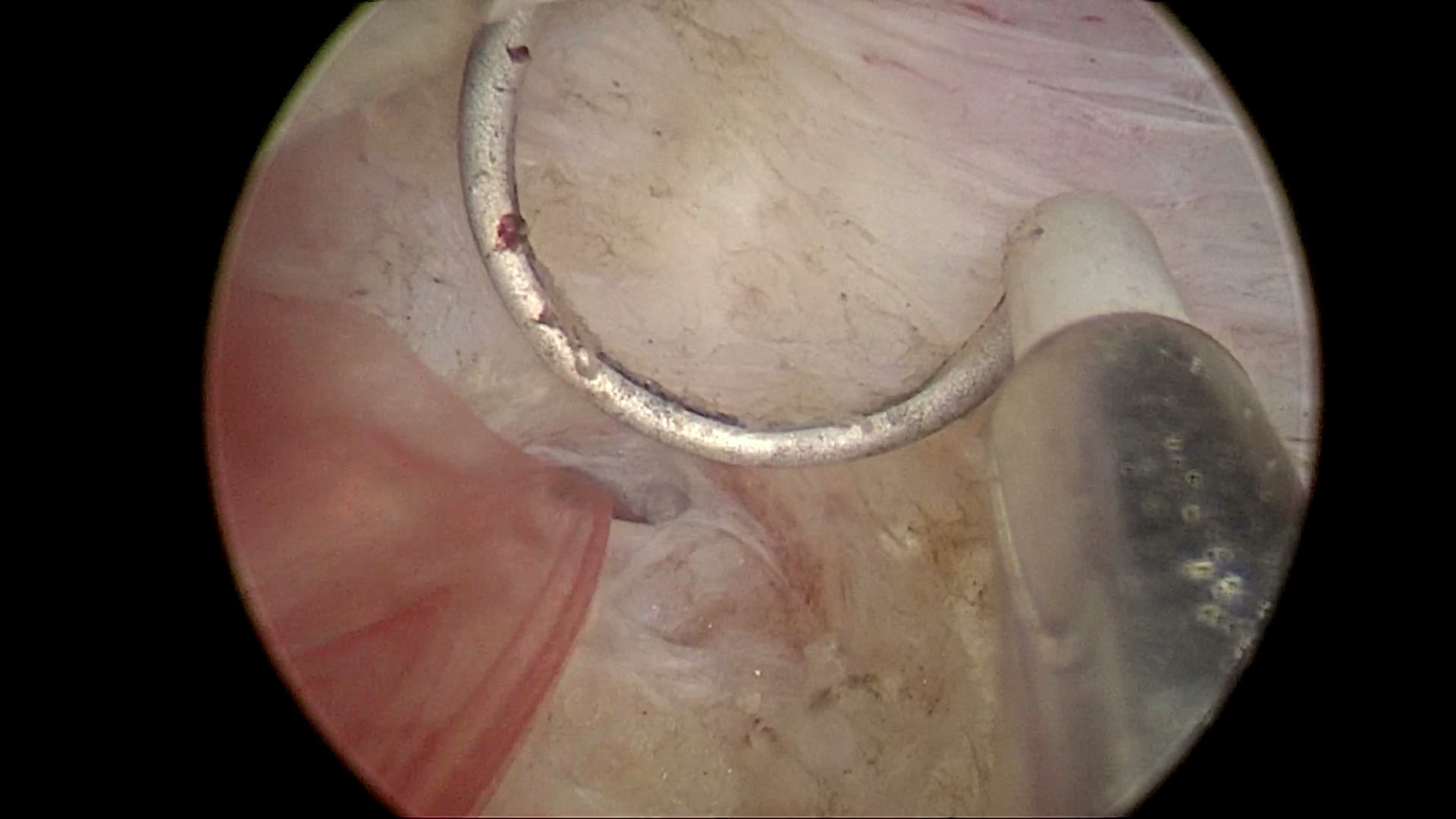 膀胱里面盐水冲洗图片