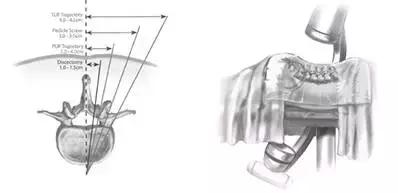 sextant Ⅱ经皮椎弓根螺钉系统