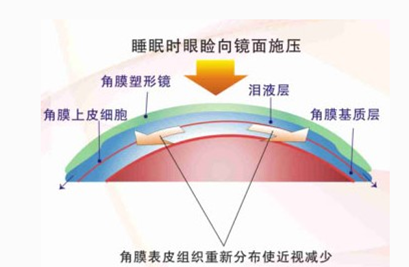 什么是角膜塑形镜