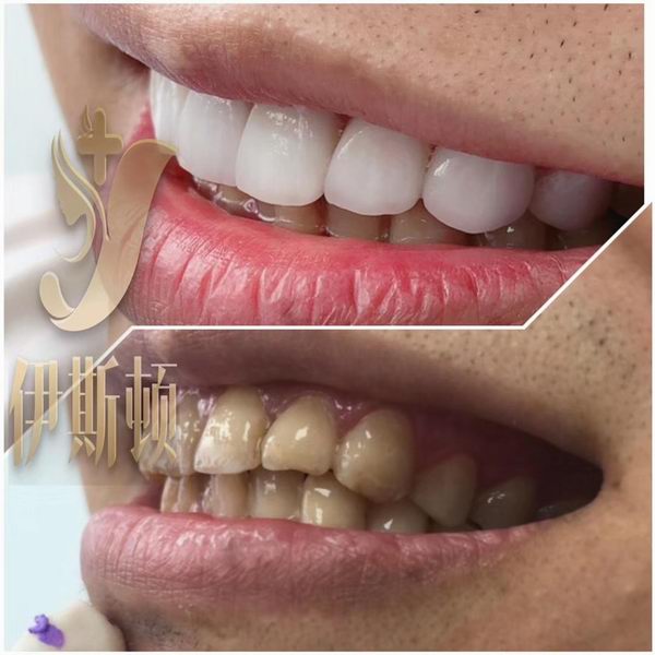 什么叫冰瓷美牙贴面?