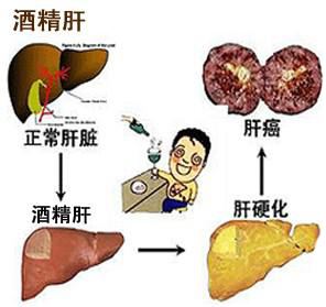 肝硬化病人口渴咋回事_肝硬化病人图片(2)