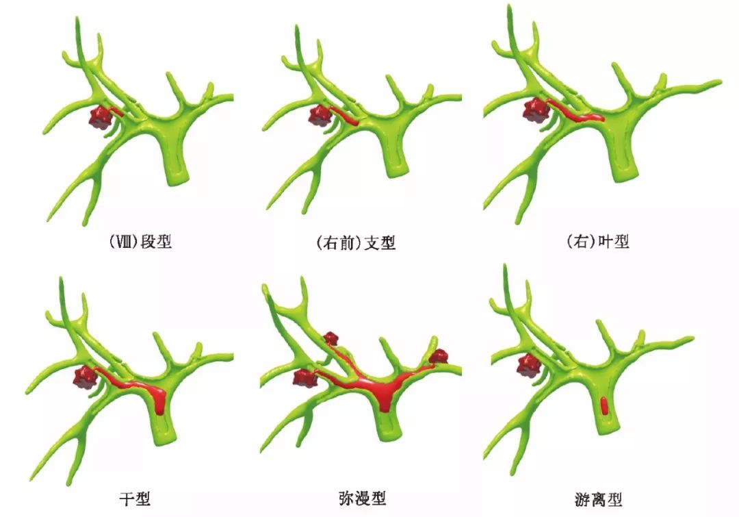 (1)段型;(2)支型(右前,右后,左内或左外:癌栓位于肝内胆管的右前支,右