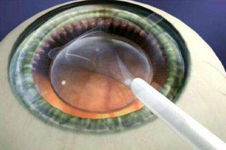 首大施玉英：年轻时做了近视手术老了后还能做白内障手术吗？
