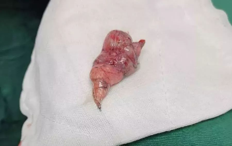 胸外科熟练开展单孔胸腔镜肺大疱切除术_手术