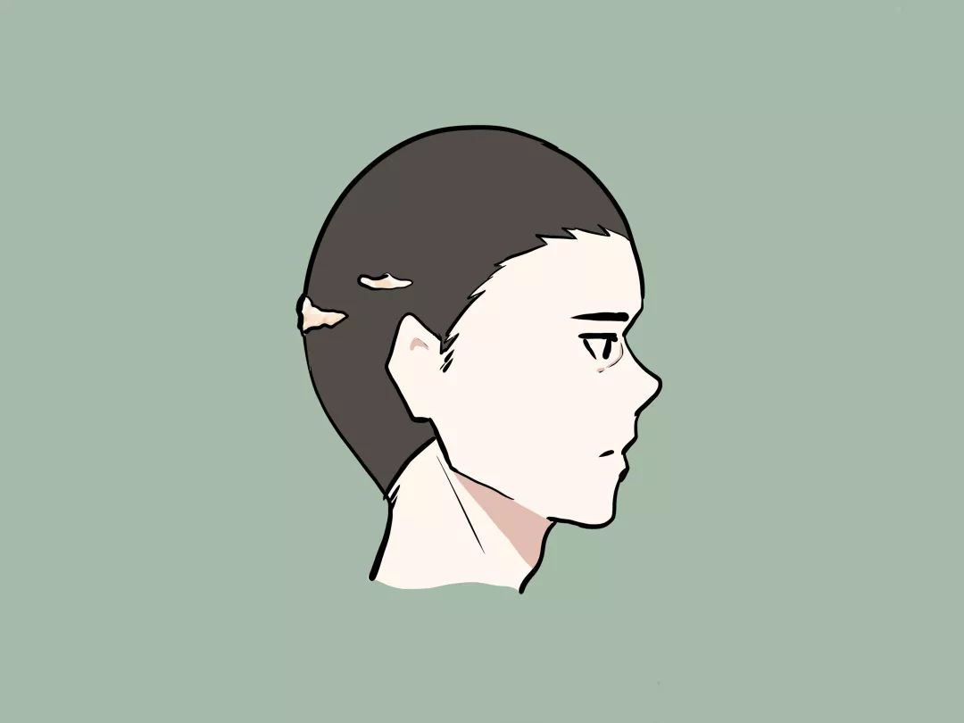 瘢痕性脱发