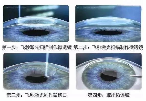 手术治疗近视眼的原理_MCT技术控制近视 非手术治疗近视的首选