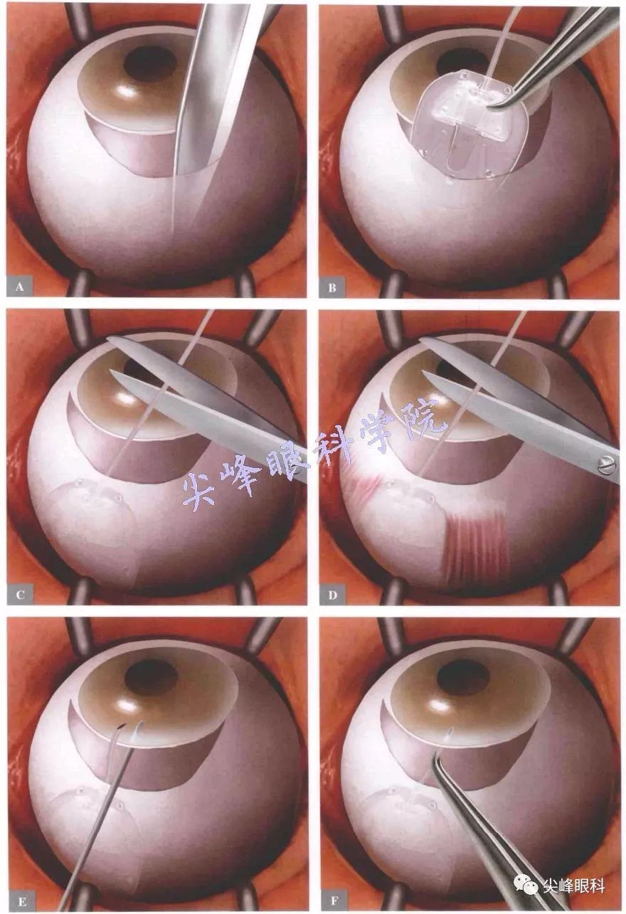 房水引流阀植入手术之手术操作 part01《图解青光眼手术操作与技巧