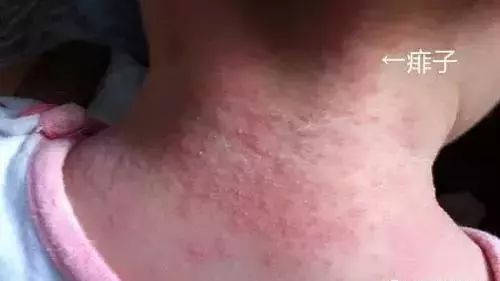 宝宝红脖子湿疹怎么办