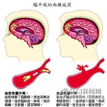 吃什么预防脑中风 5b142b784317450ea9bd952a94c4d9f0.jpeg
