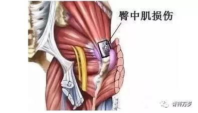 臀部腿部疼痛 梨状肌与臀中肌的重要点