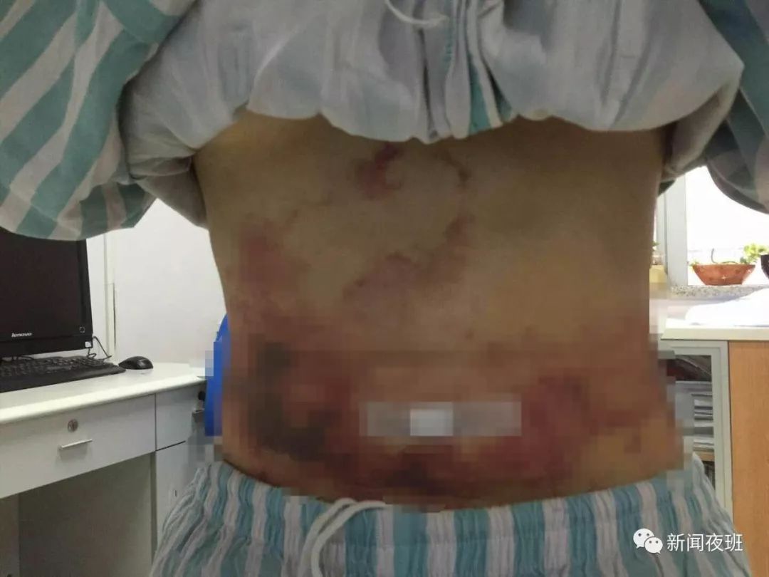 整形需谨慎!妙龄女孩吸脂手术竟“吸”出筋膜损伤 盈丰国际wjsyfx2