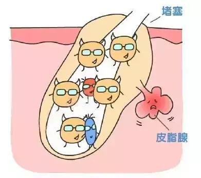 《一篇完整的关于痘痘的文章》_毛囊