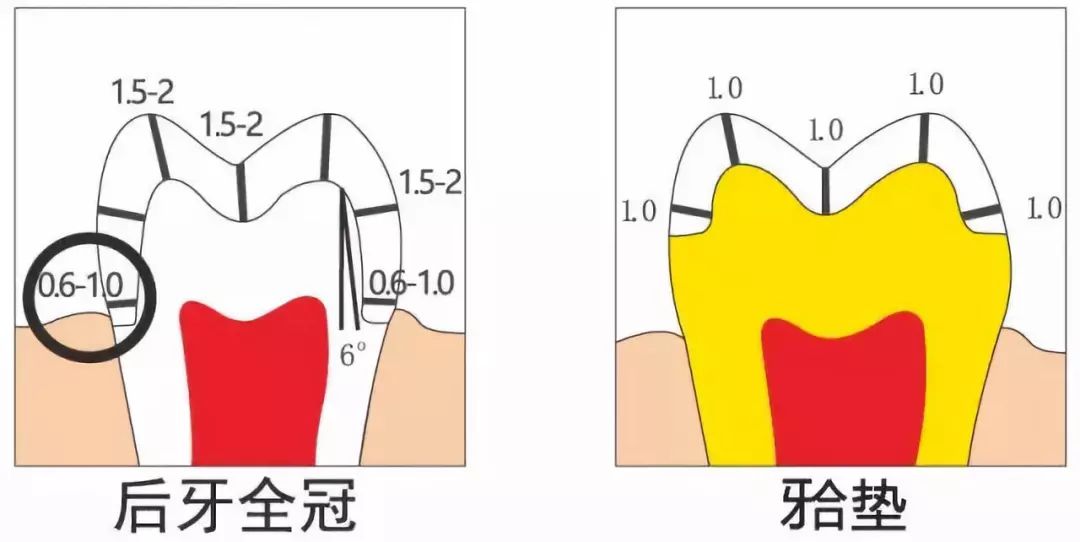 【牙医必备】牙体预备及全瓷牙备牙要求!